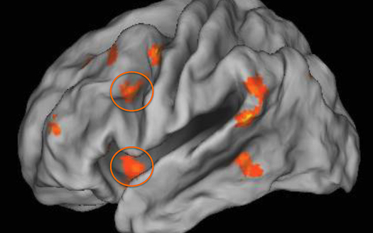 PHOTO: New research found childhood poverty impacted how much the two regions of the prefrontal cortex (as shown in orange circles) were engaged during emotion regulation. Photo: brain. Courtesy UIC.