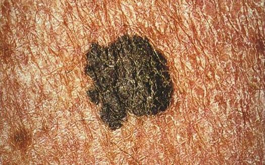 PHOTO: A scary sight. Melanoma is rare, but still a serious risk for sun-loving Oregonians. May is Skin Cancer Awareness Month, and people are being encouraged to learn more about early detection and prevention measures. Photo credit: Carl Washington, CDC.